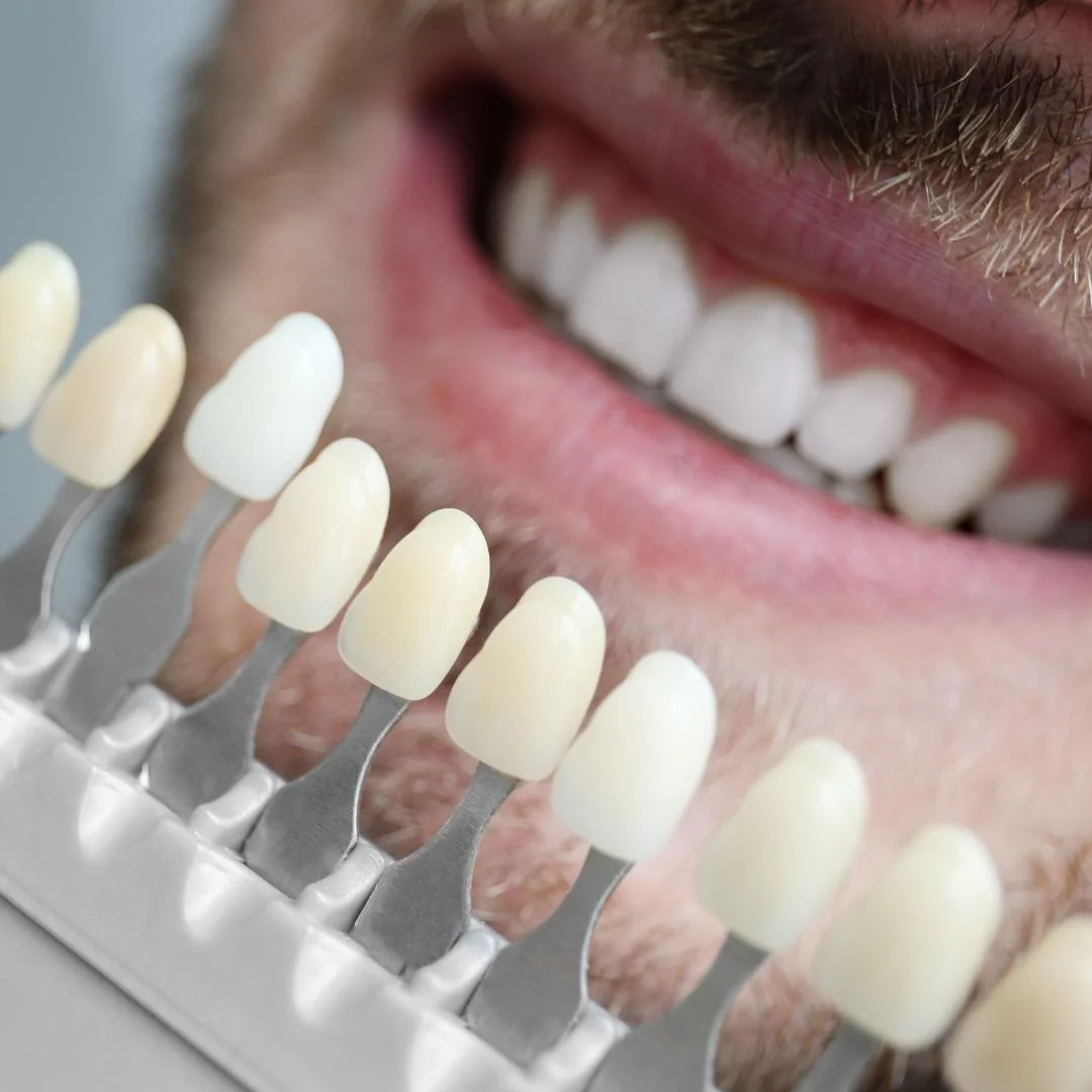 carillas-dentales-compressed (2)