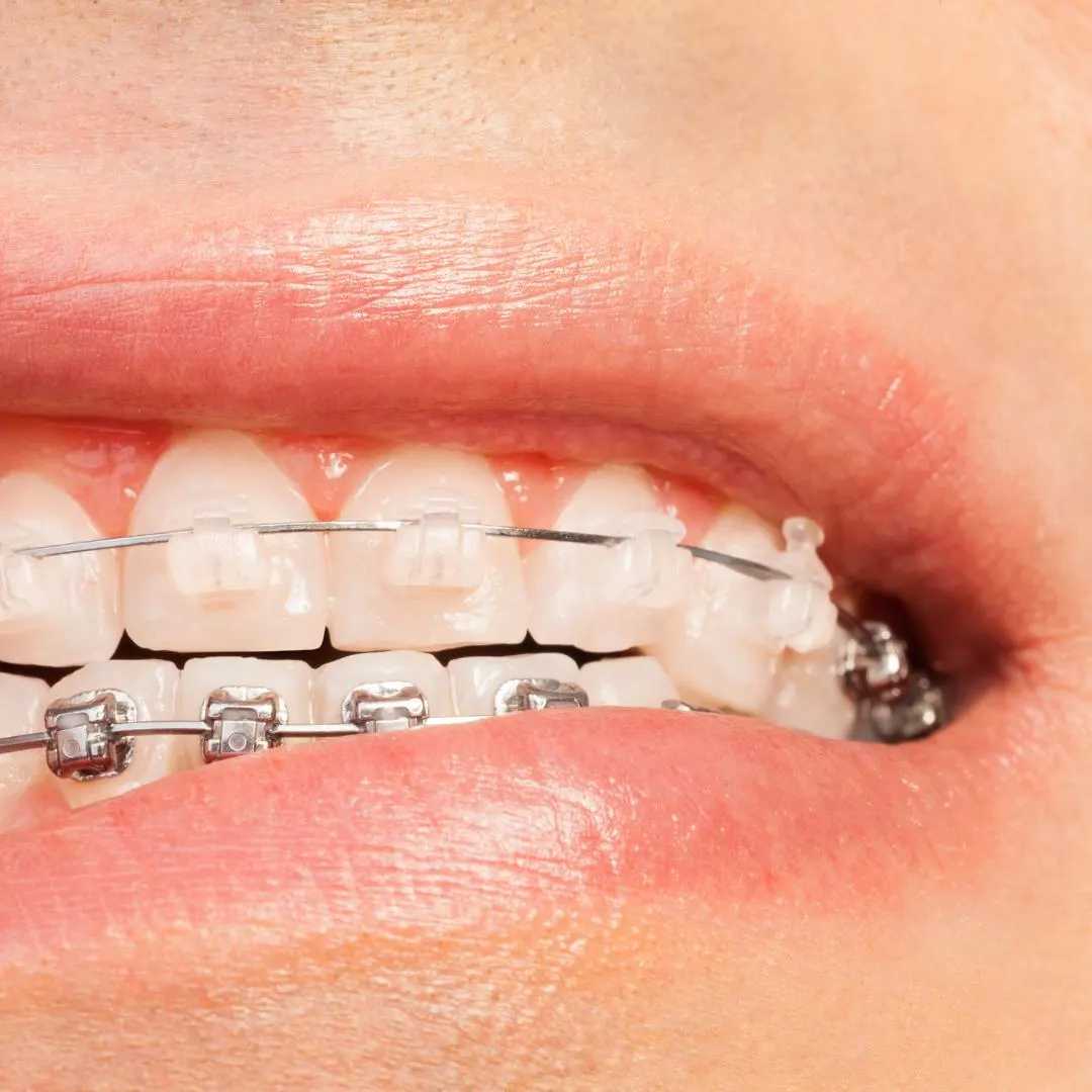 ortodoncia-para-alinear-dentadura-compressed