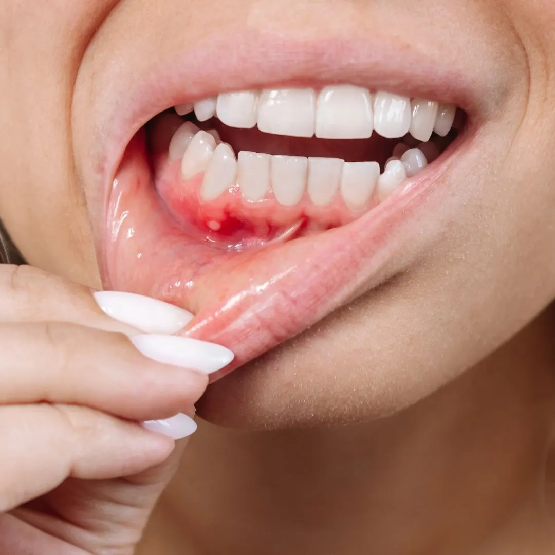 periodoncia-encias-compressed-_1_