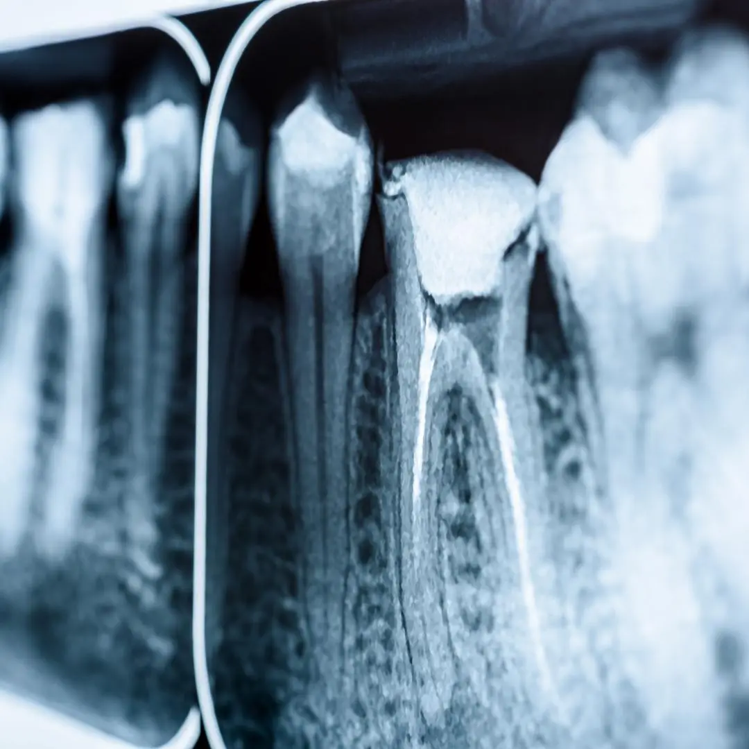 placas-implantes-dentales-compressed