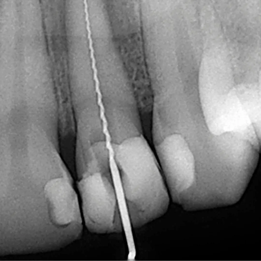 radiografia-endodoncia-compressed